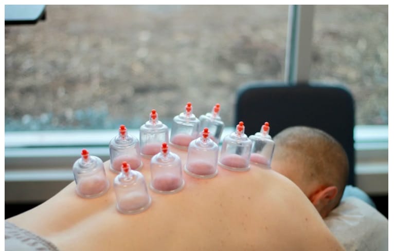 Cupping Therapy